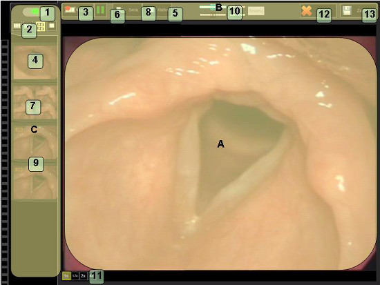 obraz z laryngowideostroboskopu