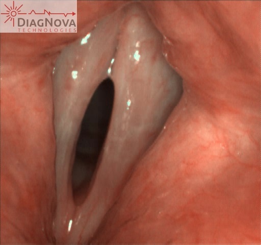 szybka kamera diagnostyka laryngologiczna foniatryczna